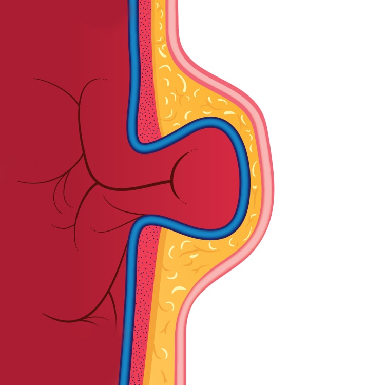 Hernia Bulge Illustration showing bowel protruding 