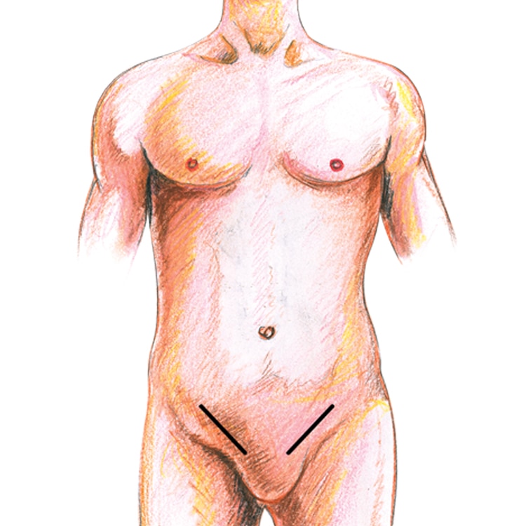 Open Hernia Repair Incisions illustration