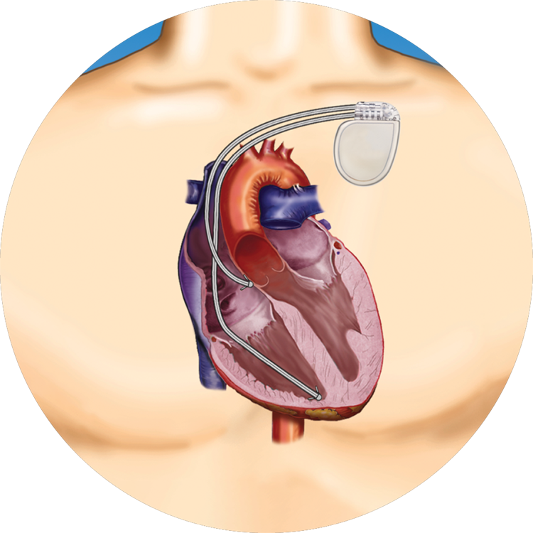 implantable cardioverter defibrillator scar