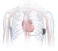 Illustrated chest demonstrating where the Aurora EV-ICD system is implanted