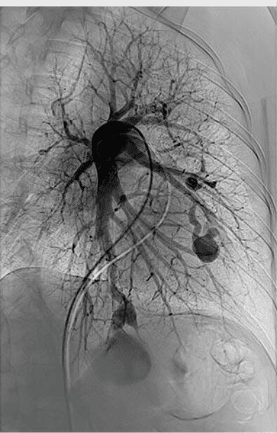 Pulmonary arteriovenous malformation pre angiogram