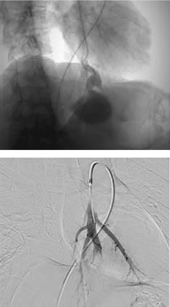 Pulmonary arteriovenous malformation pre and post treatment of left lower lobe PAVM with 9mm MVP device