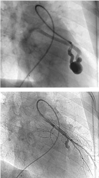 Pulmonary arteriovenous malformation pre and post treatment of left inferior lingular PAVM with 7mm MVP device
