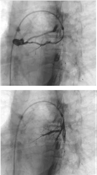 Pulmonary arteriovenous malformation pre and post treatment of left superior lingular PAVM with 5mm MVP device