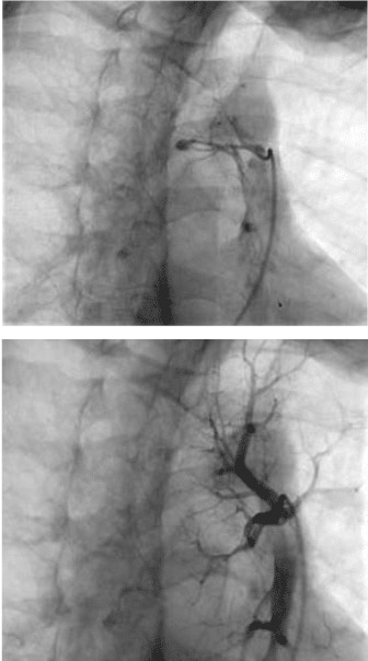 Pulmonary arteriovenous malformation pre and post left lower lobe superior PAVM with 3mm MVP device