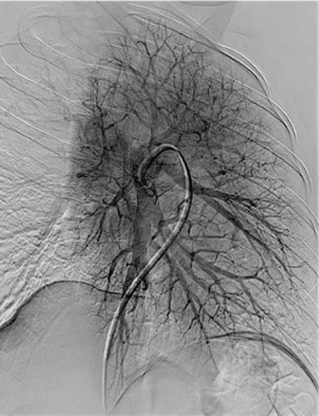 Pulmonary arteriovenous malformation final angiogram