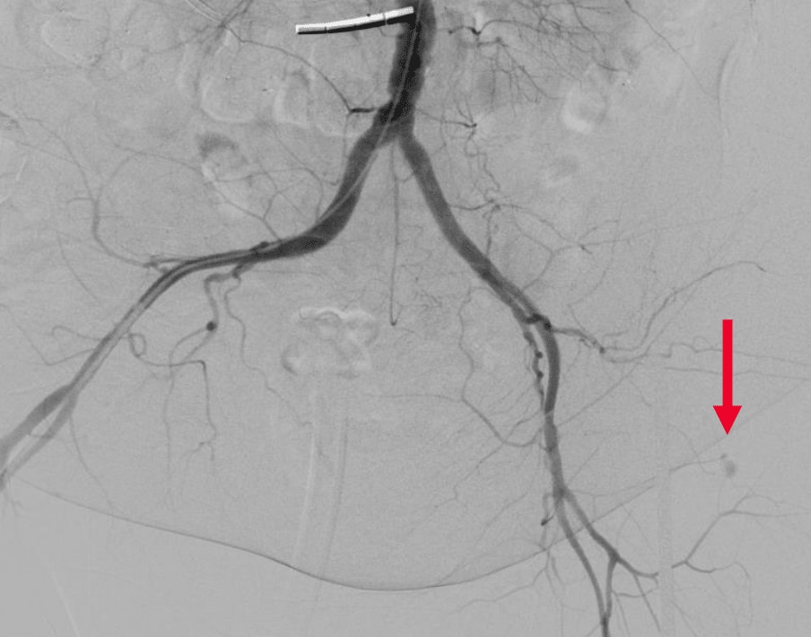 Circumflex iliac artery trauma pre angiogram 1 