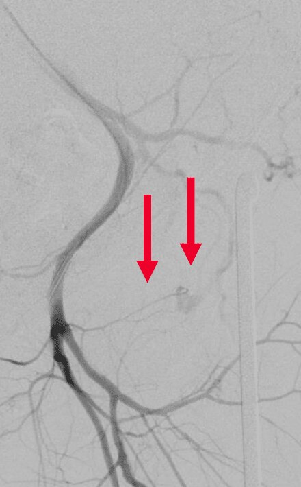Circumflex iliac artery trauma pre angiogram 2 