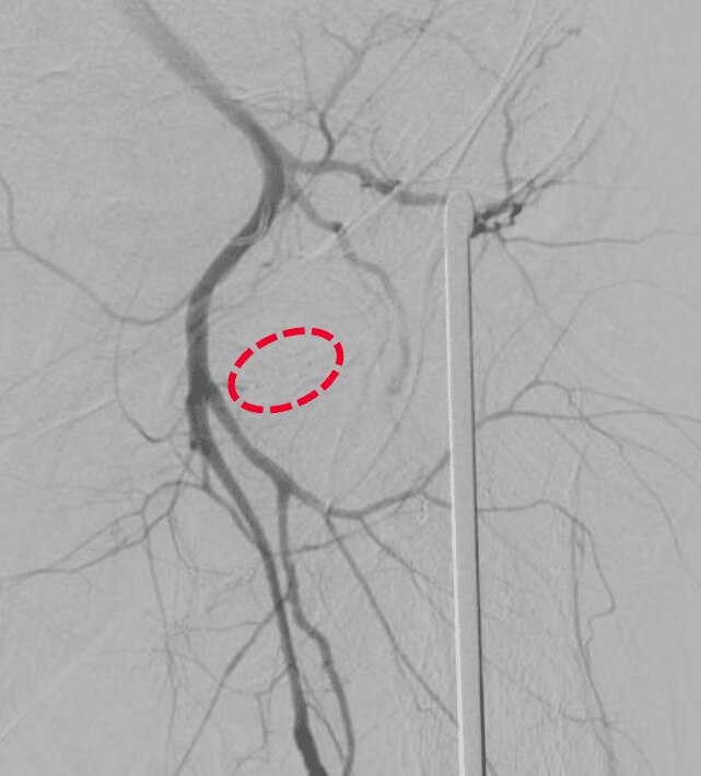 Circumflex iliac artery trauma final angiogram 