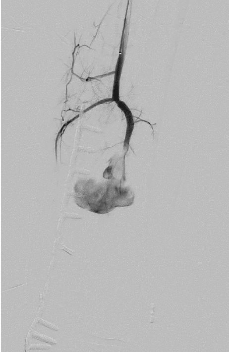 Peroneal artery pseudoaneurysm deployment of MVP device image