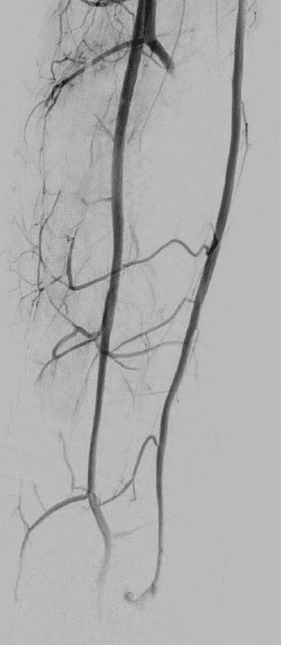 Peroneal artery pseudoaneurysm final angiogram image 