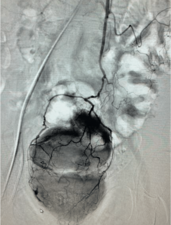 Superior rectal artery hemorrhage pre angiogram 1