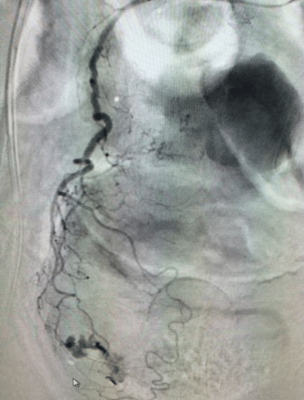 Superior rectal artery hemorrhage pre angiogram 2