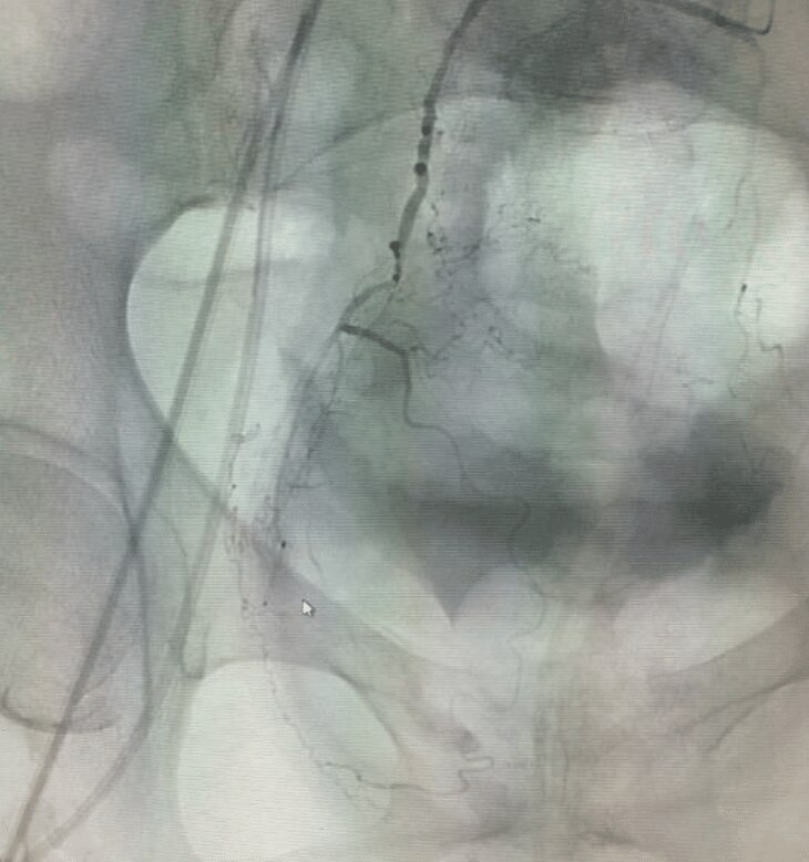 Superior rectal artery hemorrhage final angiogram